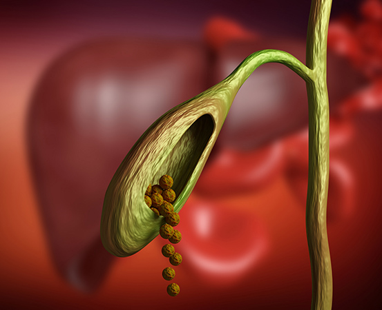 Bile duct stones are gallstones in the bile duct. They can start in the gallbladder and migrate into the bile duct or they can form in the bile duct itself