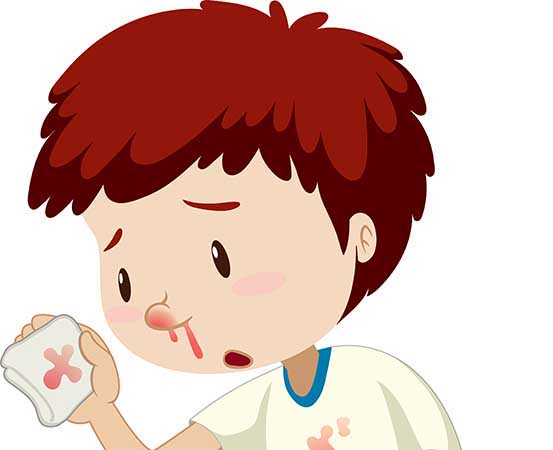 Nosebleeds among children: dos and don’ts