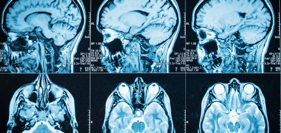 An image of CT scans showing a brain tumour
