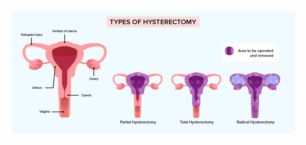 Hysterectomy is an effective treatment for early-stage cervical cancer 