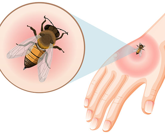 The first thing is to identify the site of the bee sting and see if the stinger is still present. If you can, remove it. 