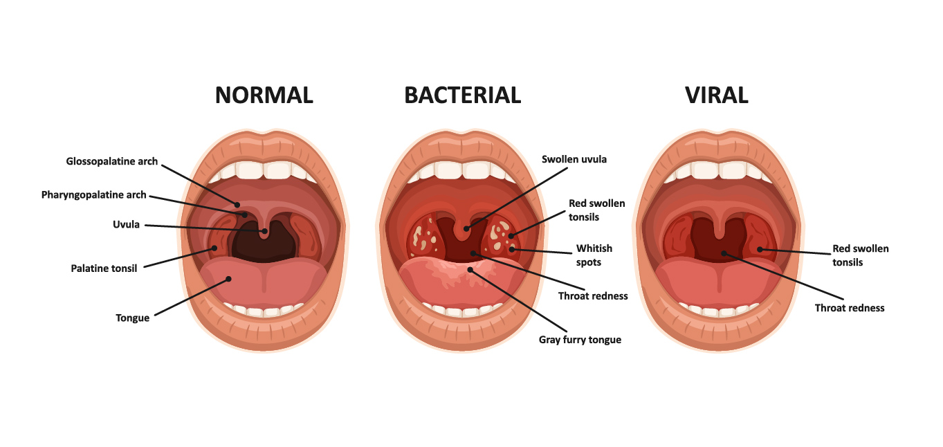 Viral and bacterial tonsils