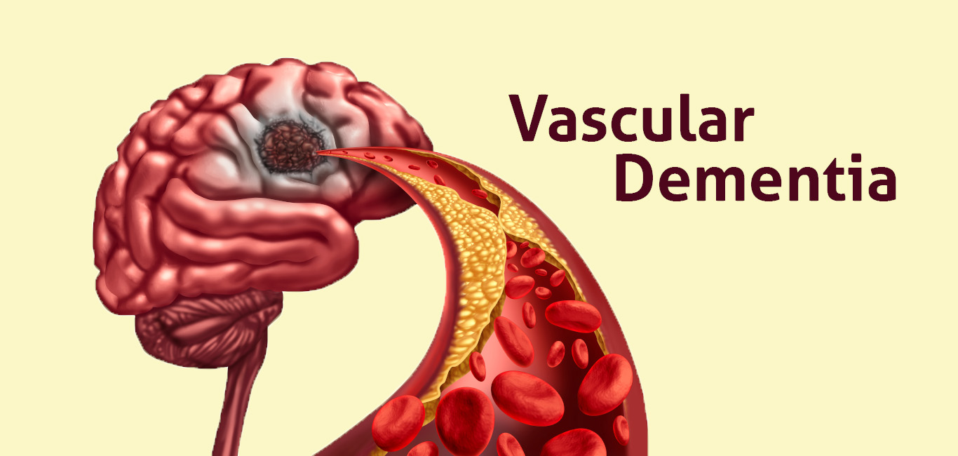 vascular dementia is caused due to decreased blood flow in the brain by plaques in the blood vessels. 