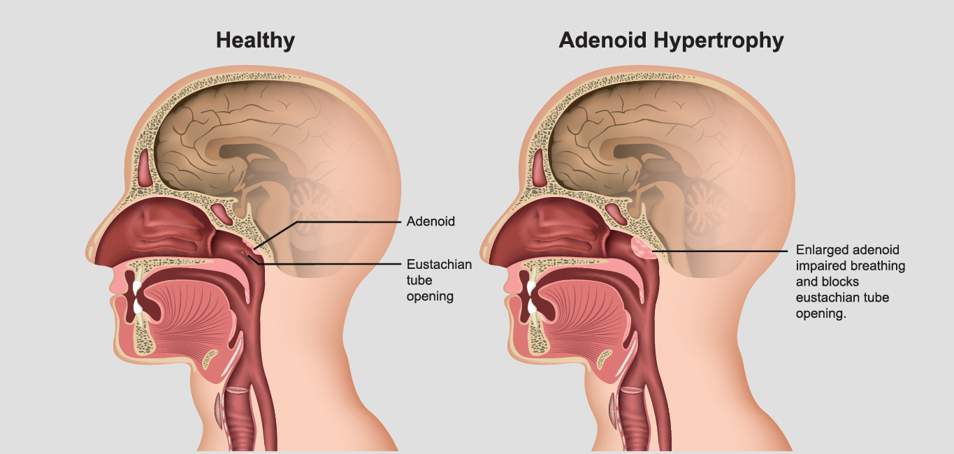 adenoids, adenoiditis, ENT, adenoidectomy 