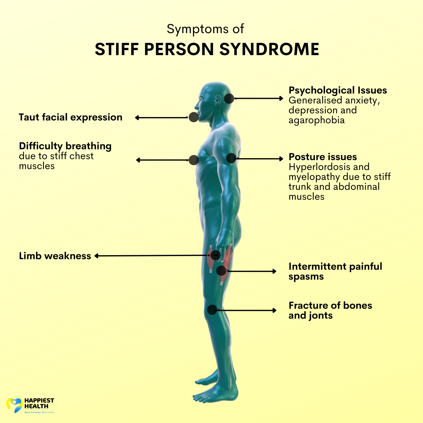 stiff person syndrome presentation