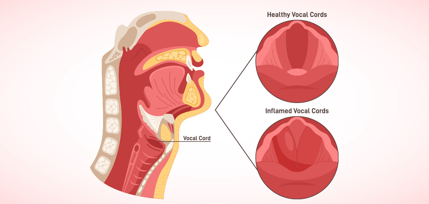  laryngitis, sore throat, hoarse voice, throat pain, vocal cords, voice box 