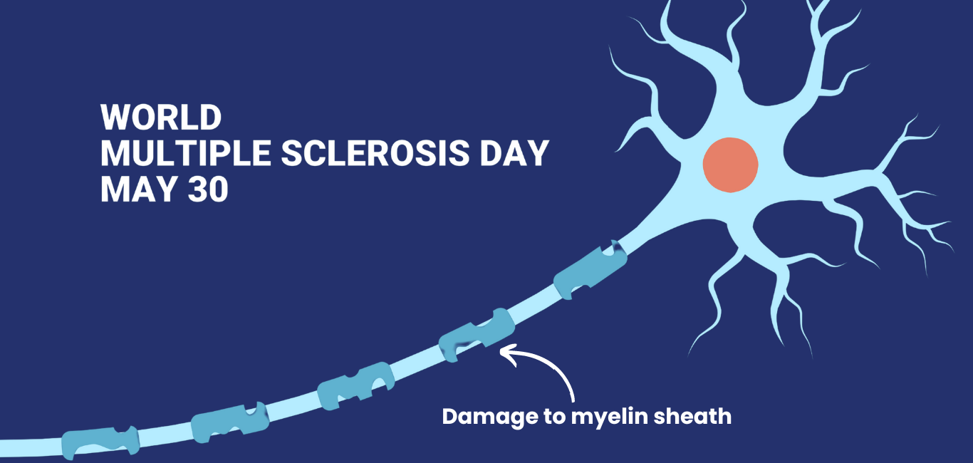 Mutiple Sclerosis research strides. Damaged Myelin Sheath. World Multiple sclerosis day
