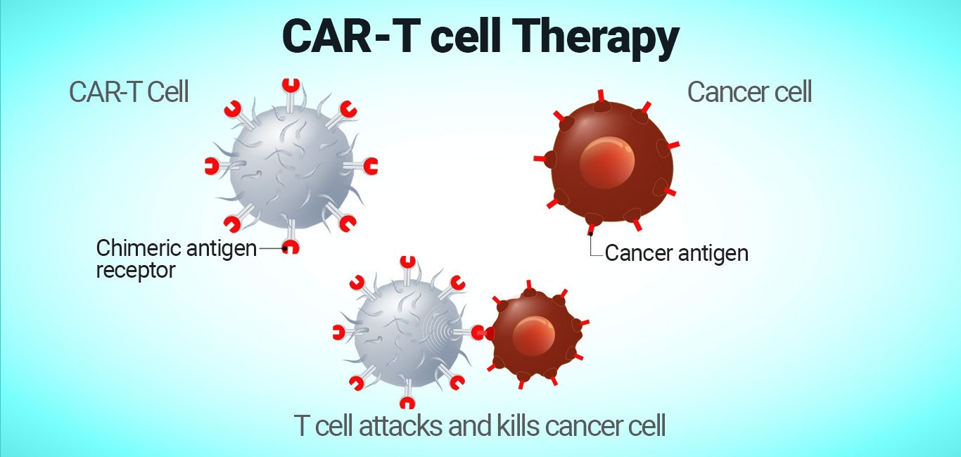 CAR-T cell therapy uses a person's immune cells and engineers them to recognise and kill the tumour
