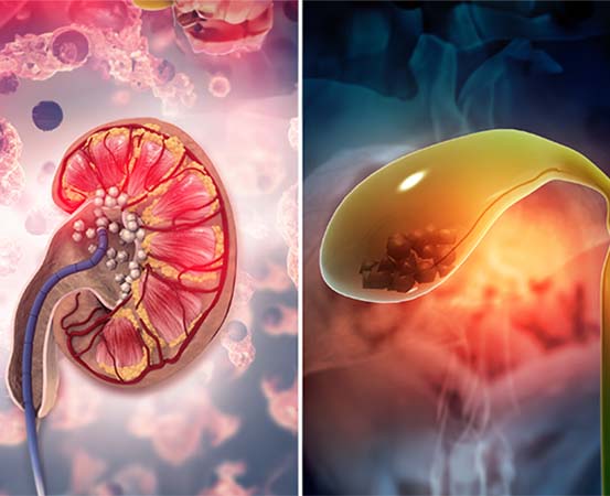 Kidney stones and gallstones can cause severe pain when they get stuck, obstructing the natural flow of urine and bile, respectively