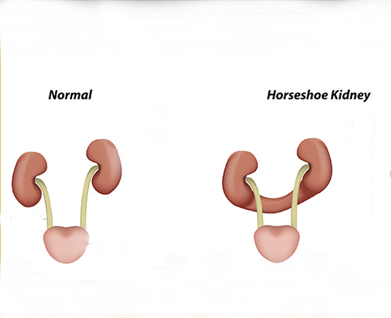 Horseshoe kidney is a congenital condition where the two kidneys are fused into a U-shaped structure resembling a horseshoe