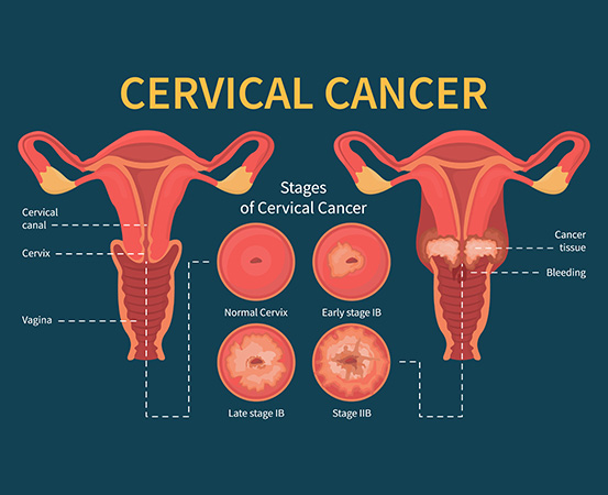 The early signs of cervical cancer can mimic symptoms of menopause