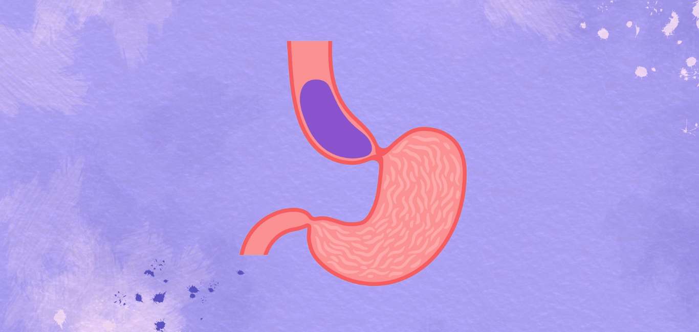 Achalasia is a rare disorder in which lower oesophageal sphincter fails to contract